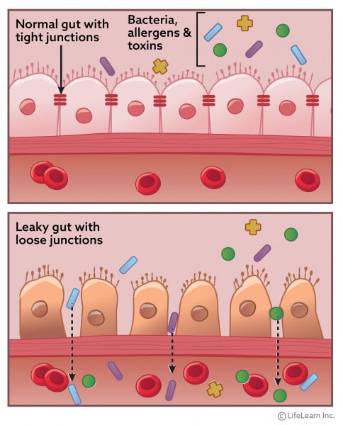 leaky gut (1)